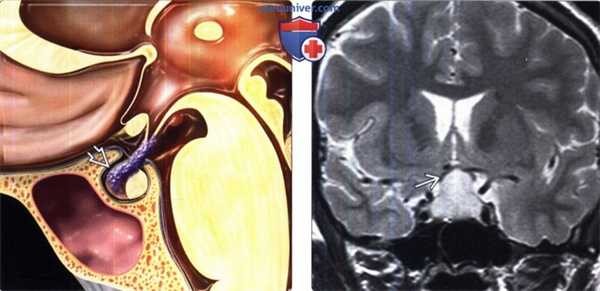 Лимфоцитарный гипофизит на МРТ головного мозга