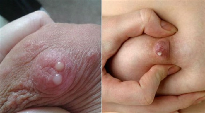 Галакторея