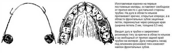 Скользящая дуга (аппарат) Энгля