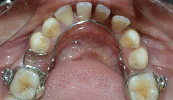 Конструктивные особенности аппарата Мершона