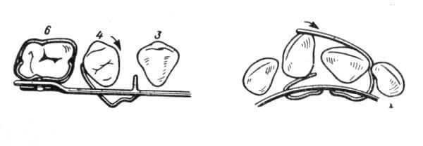 Как действует аппарат Мершона