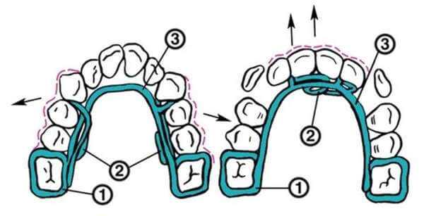 Какие задачи помогает решить аппарат Мершона