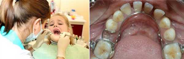 Изготовление аппарата Мершона