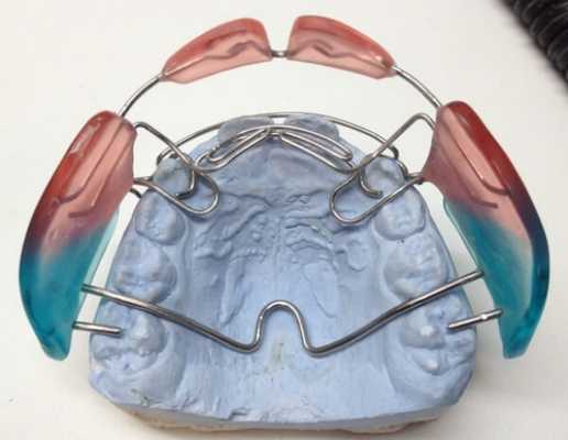 Как действует аппарат Френкеля