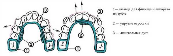 Аппарат Мершона