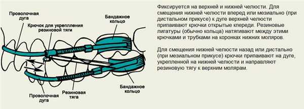 Функциональный аппарат Энгля межчелюстного действия