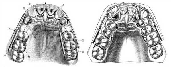 Функциональный аппарат Энгля