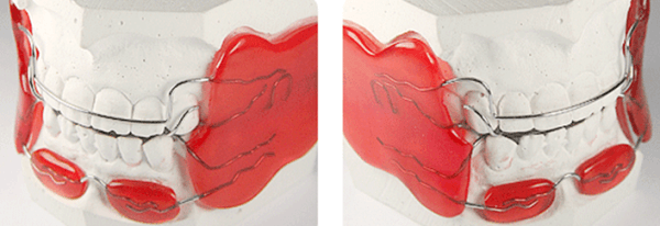 Как выглядит аппарат Френкеля