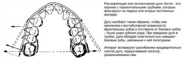 Расширяющая дуга Энгля