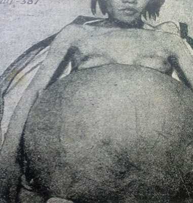 Гигантская киста яичника у 40-летней китаянки.