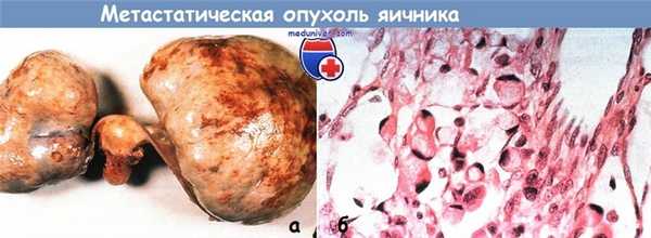 Метастатическая опухоль яичника