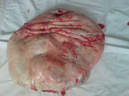 Фото №7 (гигантская опухоль яичника 700х500х500 мм).
