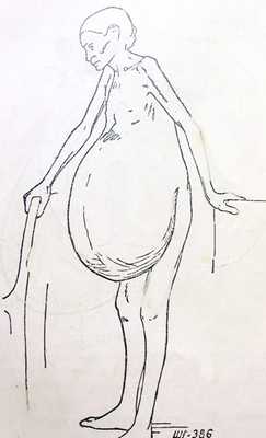 Женщина с громадной опухолью яичника. Резкое исхудание. Окружность живота 160 см (Штеккель В.) [5].