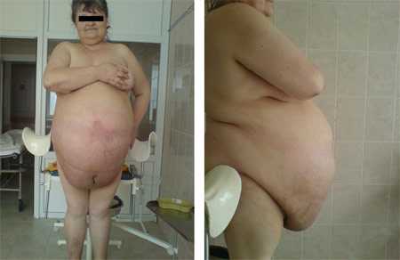 Фото №4, 5 (после эвакуации асцита – 30 л жидкости).