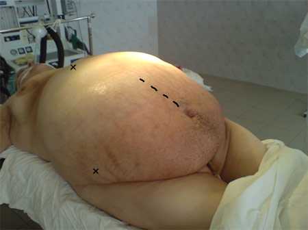 Фото №6 (разметки для оперативного доступа относительно костных ориентиров).