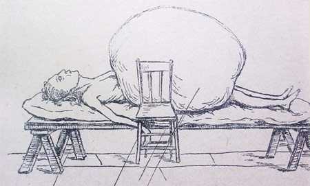 Колоссальная киста (Славянский).