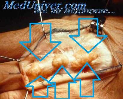 нарушения обмена при подагре