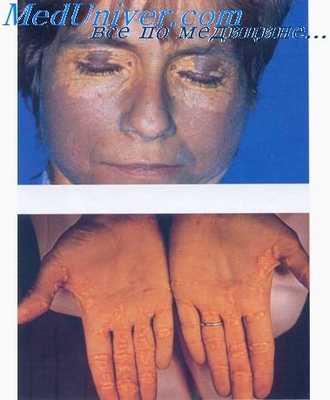 гистиоцитоз фута