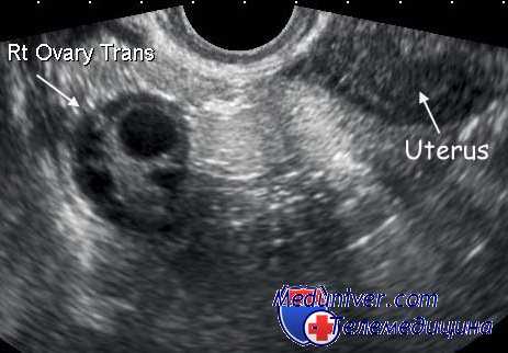 маскулинизирующая опухоль яичника