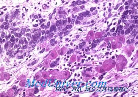 липоидоклеточные опухоли