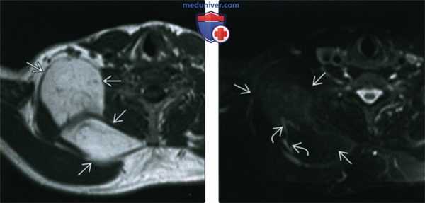 КТ, МРТ, УЗИ при липоме головы и шеи