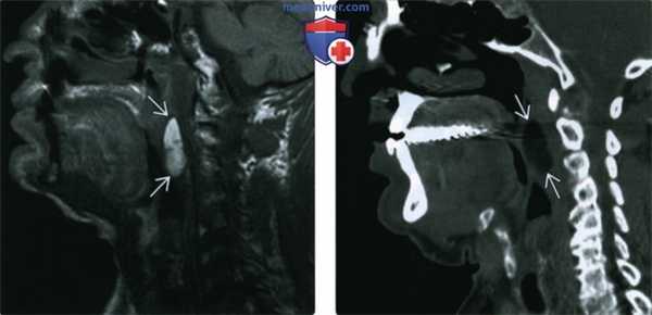 КТ, МРТ, УЗИ при липоме головы и шеи