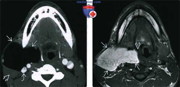 КТ, МРТ, УЗИ при липоме головы и шеи
