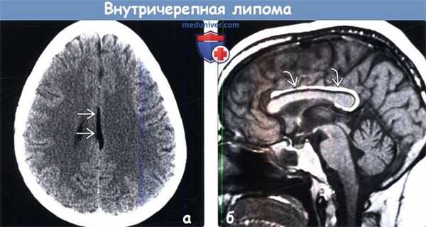 Липома головного мозга на КТ, МРТ
