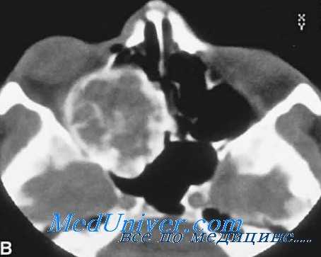 хондрома глаза