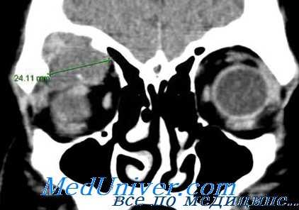 липома глаза