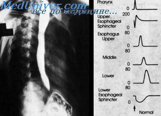 опухоли пищевода