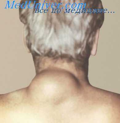 остеолипома