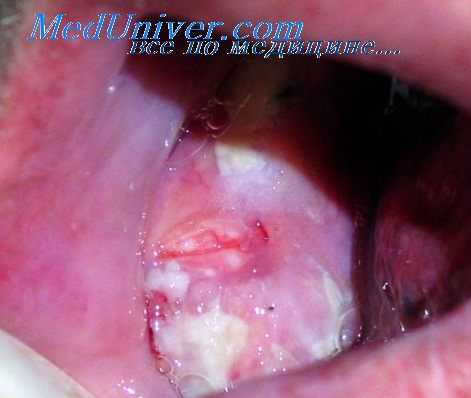 липома полости рта