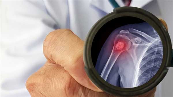 Что такое хондрома?