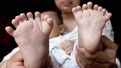 Пороки развития нижних конечностей