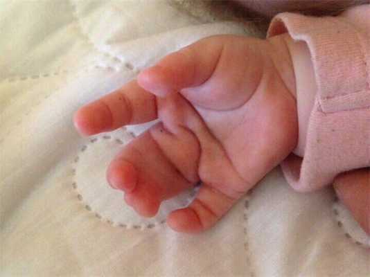 Пороки развития верхних конечностей