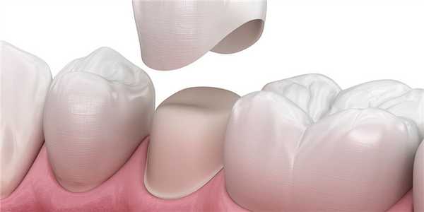 Коронки на жевательные зубы