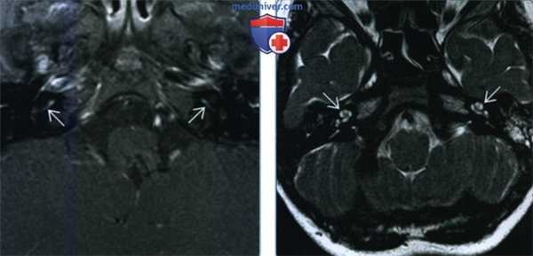 Лабиринтит - лучевая диагностика