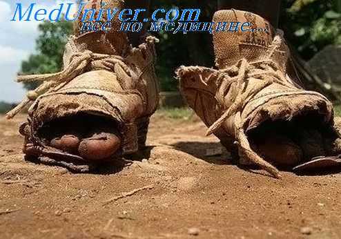 лихорадка при туберкулезе