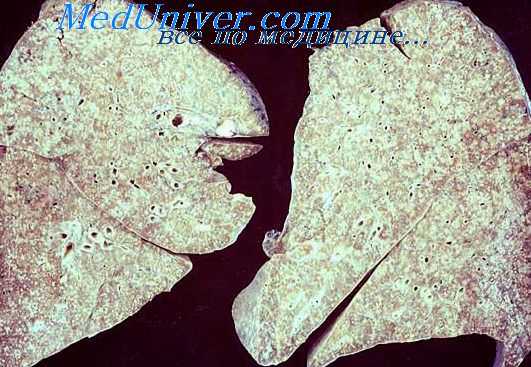 туберкулез легких