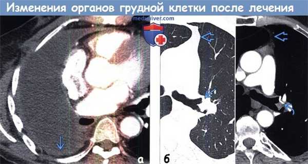 Изменения органов грудной клетки после лечения на КТ