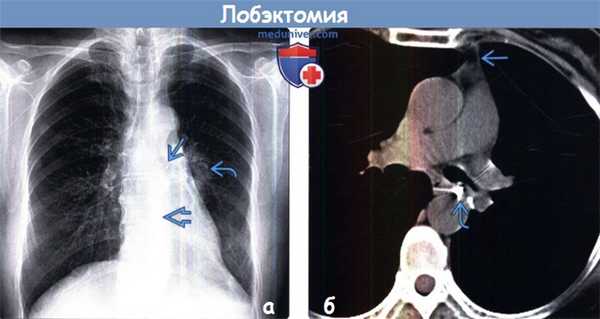 Лобэктомия на рентгенограмме, КТ