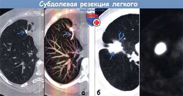 Признаки субдолевой резекции легкого на КТ, ПЭТ