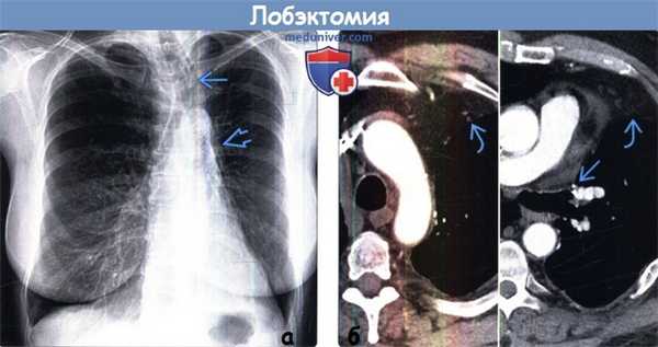 Лобэктомия на рентгенограмме, КТ