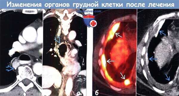 Изменения органов грудной клетки после лечения на КТ, ПЭТ