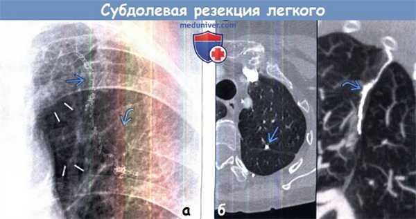 Признаки субдолевой резекции легкого на рентгене, КТ