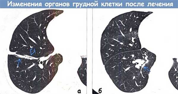 Изменения органов грудной клетки после лечения на КТ