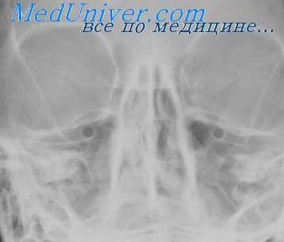 опухоли полости носа