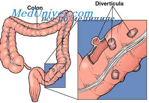 рак тонкой кишки