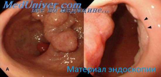 опухоли тонкого кишечника